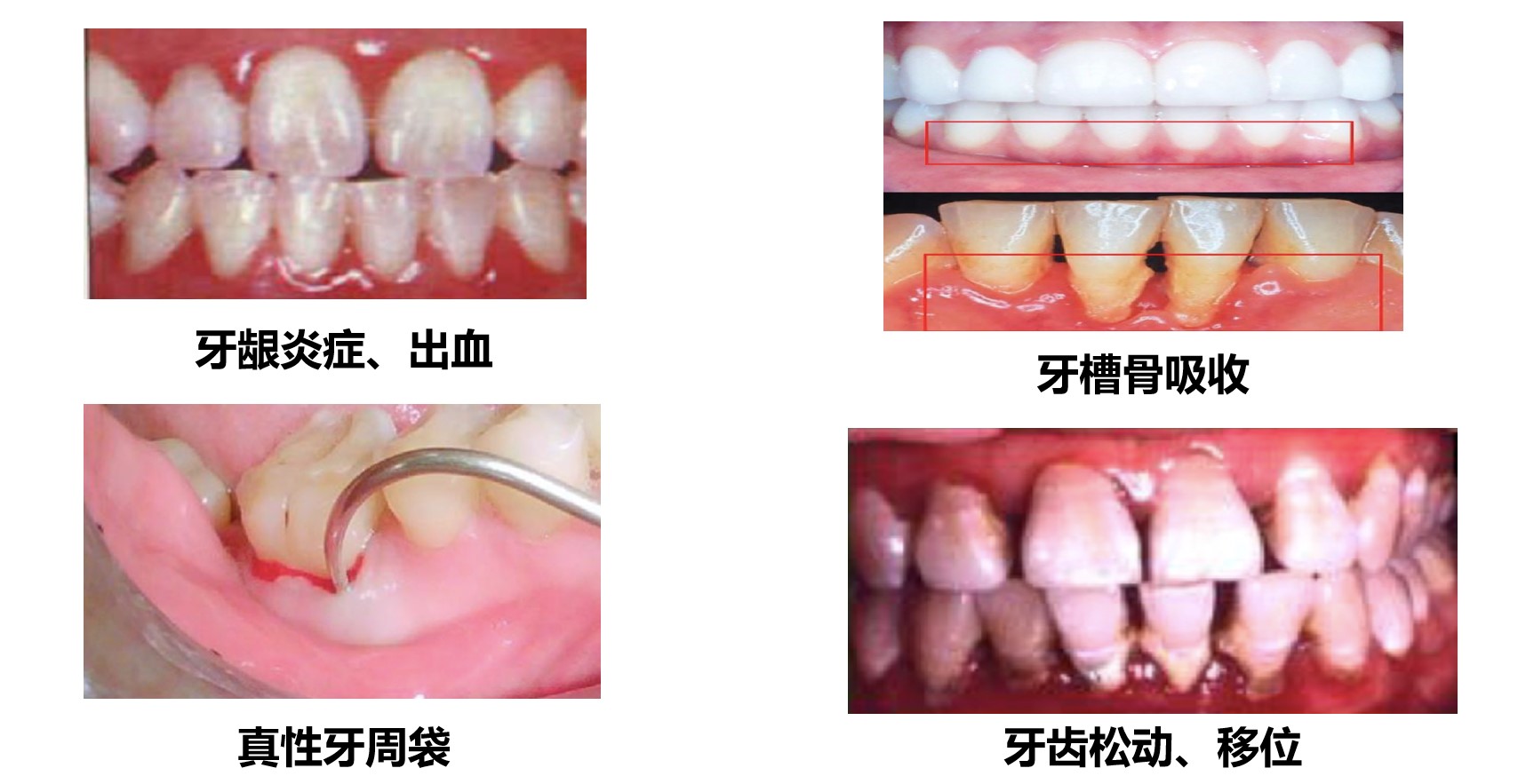 宜蘭牙周治療，鞏固牙齒地基 - 幸福牙醫宜蘭 | 牙周病 | 宜蘭縣